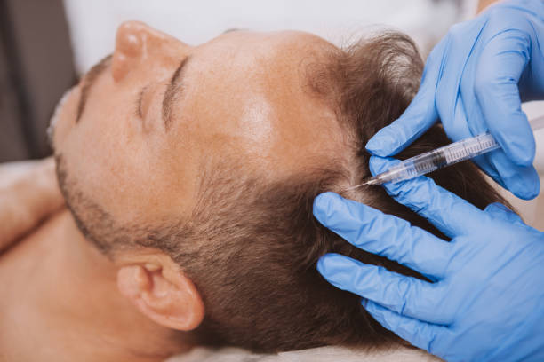 hair transplant